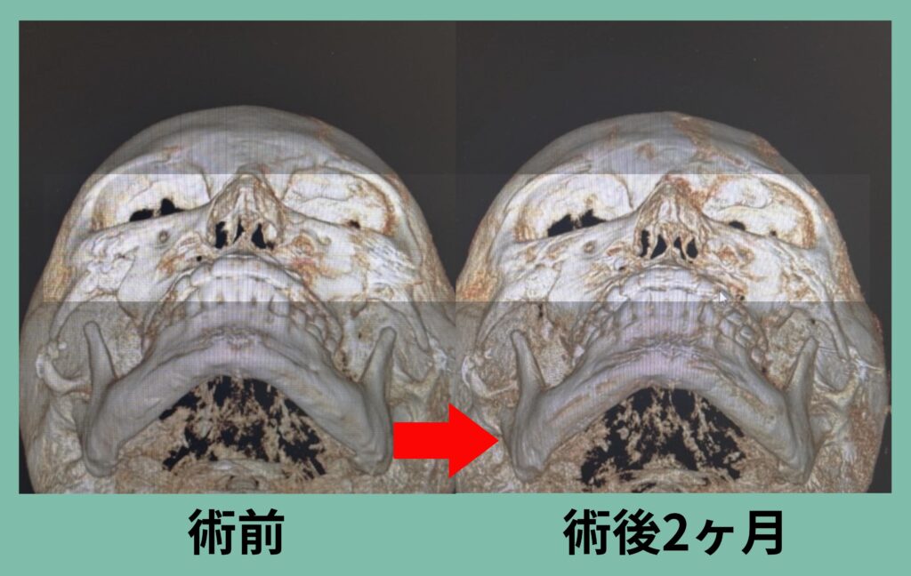 下部アイホールボーン削り