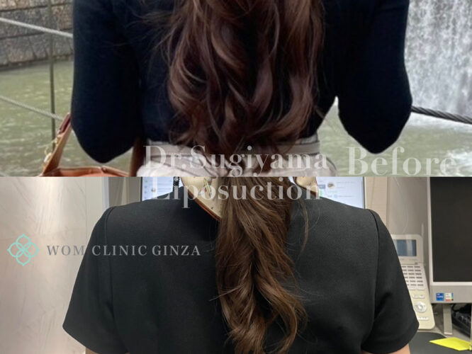 二の腕脂肪吸引 術後6ヶ月 術前 Before After