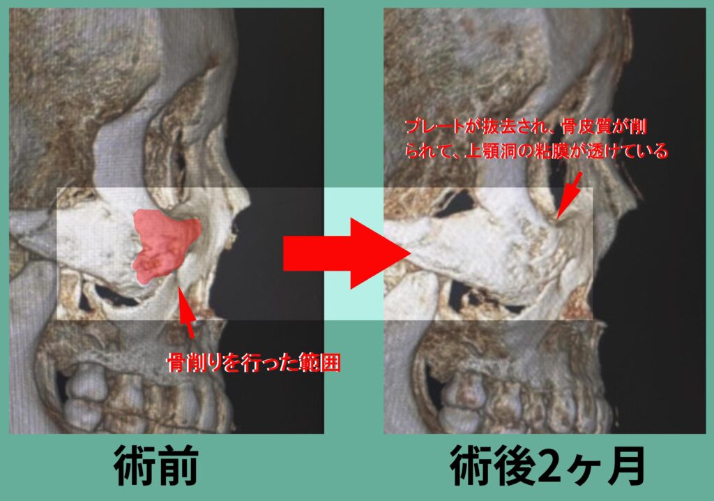 下部アイホールボーン削り