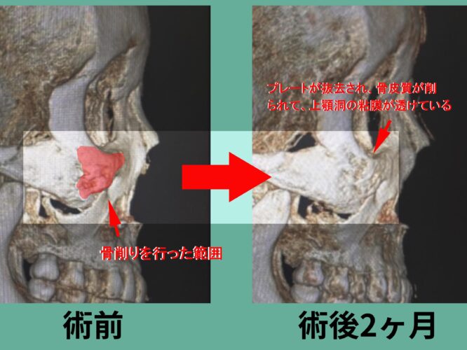 下部アイホールボーン削り