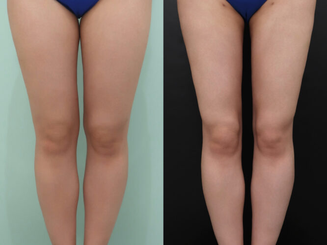 太もも脂肪吸引 ふくらはぎ脂肪吸引 脚フル脂肪吸引 術前　術後半年 Before After