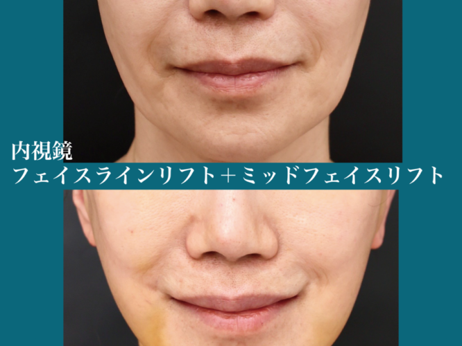 内視鏡フェイスリフト ポニーテールリフト