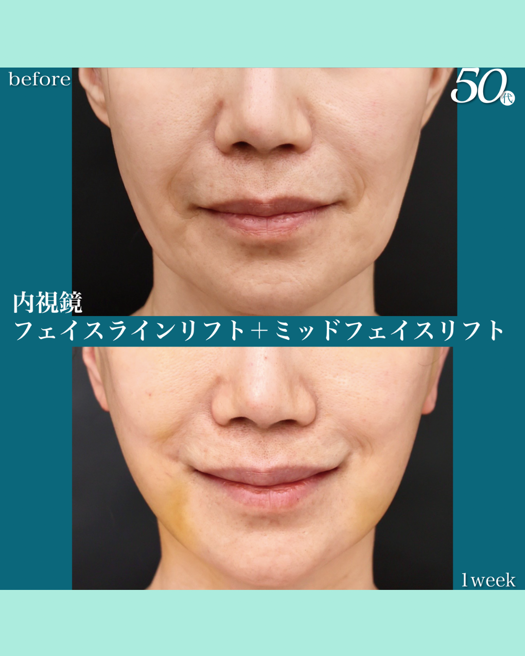 内視鏡フェイスリフト ポニーテールリフト