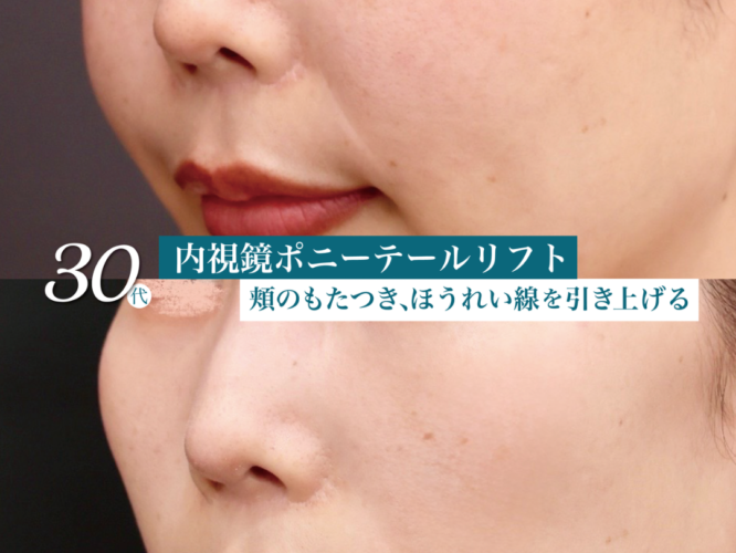 ポニーテールリフト