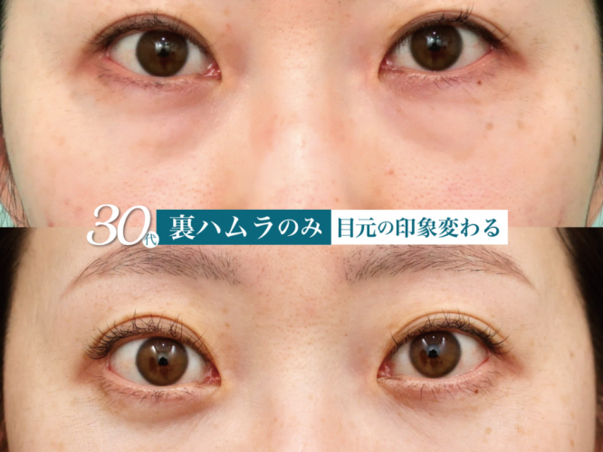 裏ハムラ