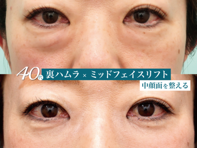 裏ハムラ　ミッドフェイスリフト