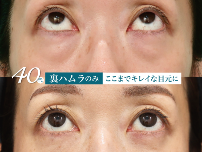 裏ハムラ　術後一ヶ月