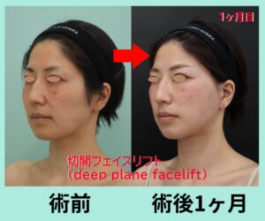 deep plane face lift術後一ヶ月目、左斜位比較写真