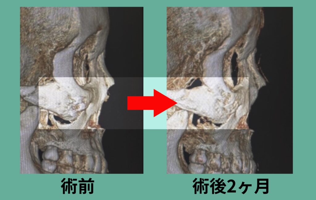 下部アイホールボーン削り