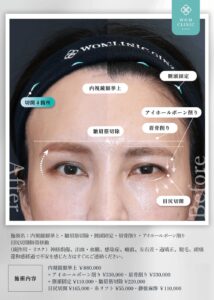 眉骨削りの症例1