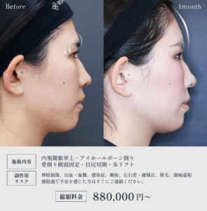 眉骨削りの症例3