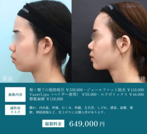 顎下脂肪吸引ビフォーアフター01