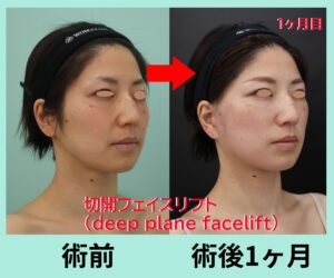 deep plane face lift術後一ヶ月目、右斜位比較写真