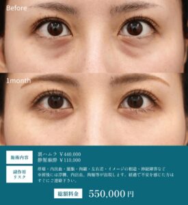 目の下のたるみ取り手術のビフォーアフター1