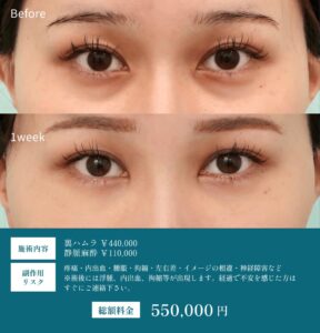目の下のたるみ取り手術のビフォーアフター2