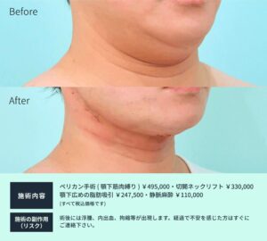 ペリカン手術の症例01