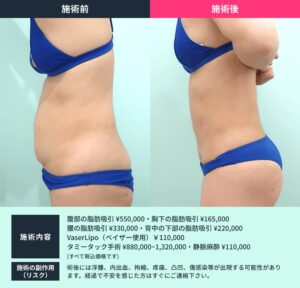 腹部脂肪吸引とタミータック手術の術前と術後の比較写真