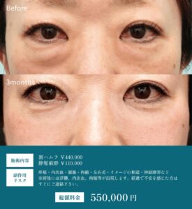 目の下のたるみ除去前後の比較