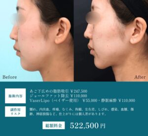 顎下脂肪吸引ビフォーアフター02