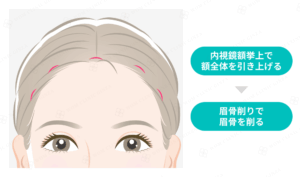 眉骨削りの施術箇所