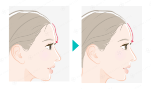 額のくぼみが改善された女性のイラスト比較