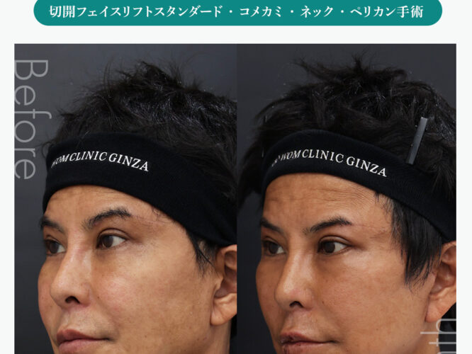 1046 切開フェイスリフト、フェイスリフト、フルフェイスリフト