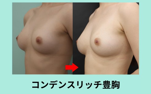 脂肪豊胸（コンデンスリッチ豊胸）