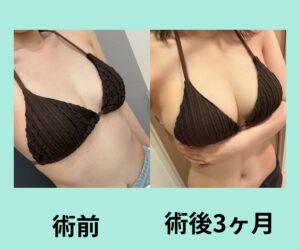 コンデンスリッチ豊胸の確かな効果!