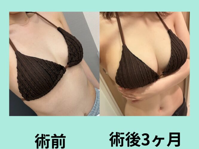 コンデンスリッチ豊胸の確かな効果！