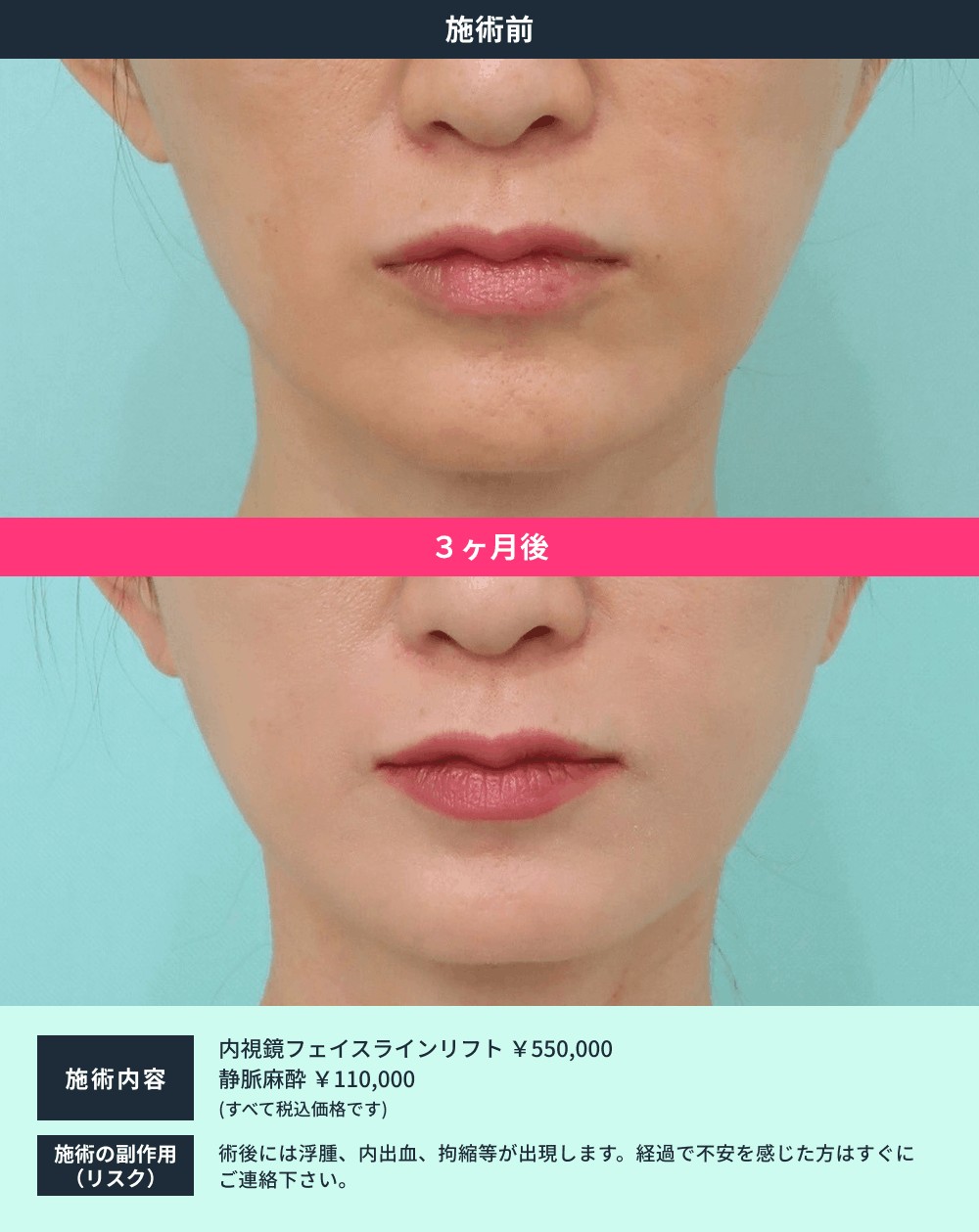 フェイスリフト症例03