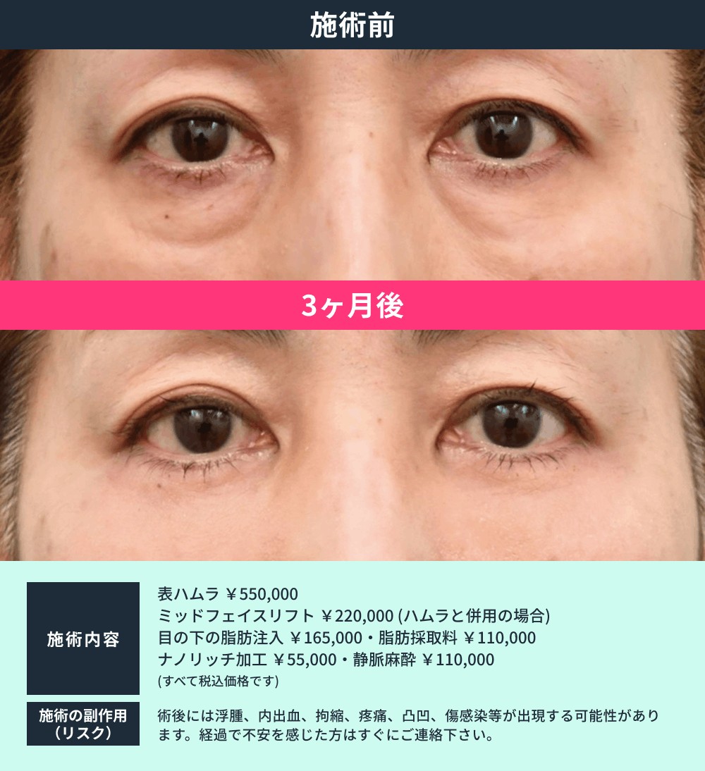 表ハムラ法 症例01