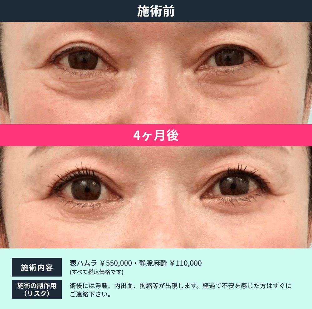 表ハムラ法 症例02