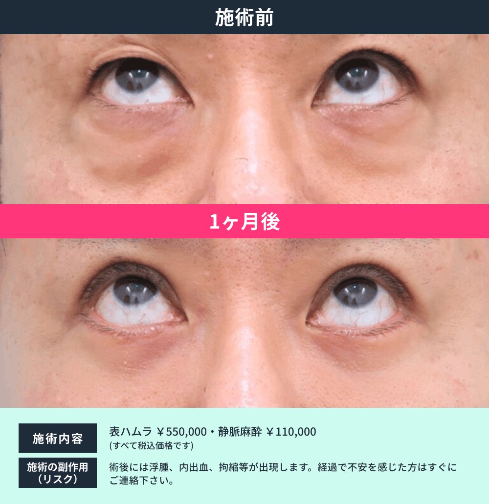 表ハムラ法 症例04
