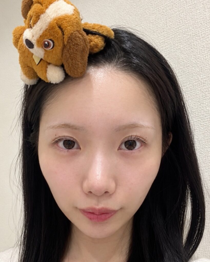 目の開きを改善 BEFORE写真