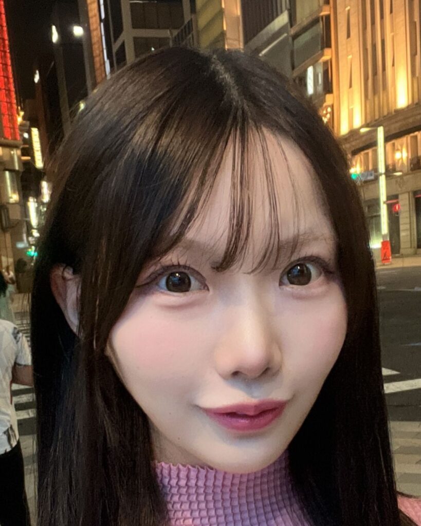 目の開きを改善 AFTER写真
