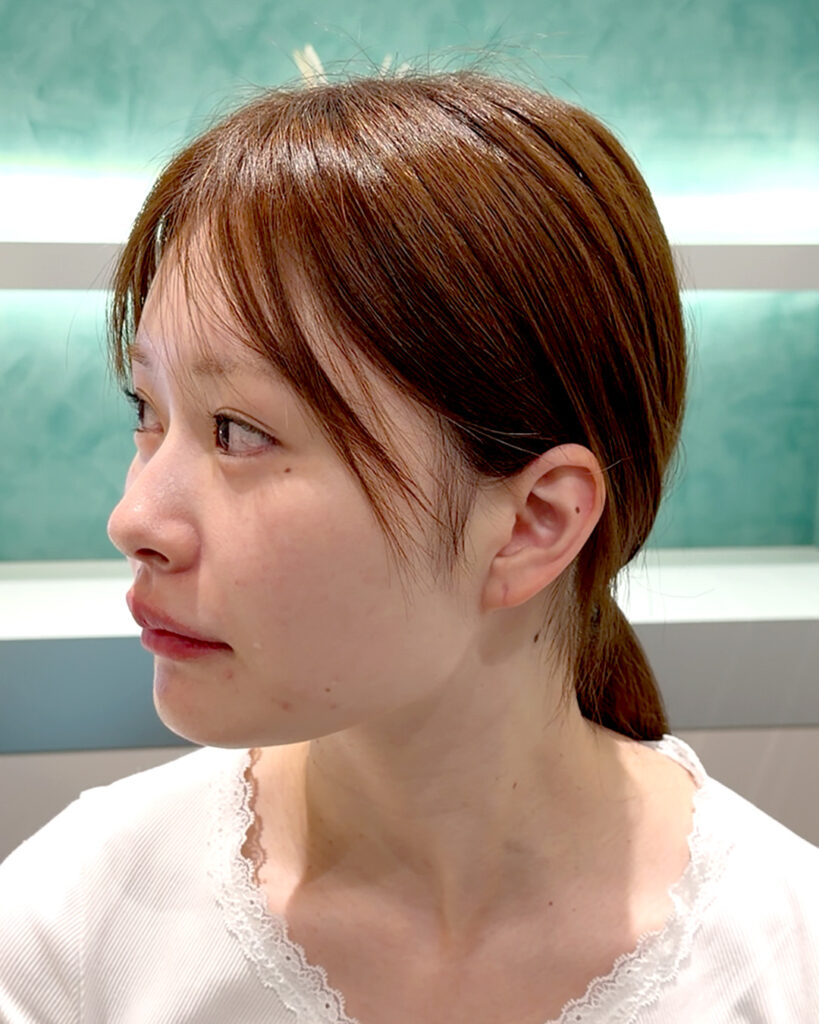 輪郭3点で卵輪郭 BEFORE写真
