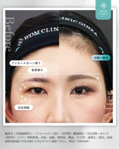 眉骨削り・アイホールボーン削り・目尻切開の施術部位と切開位置