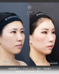 眉骨削り術前術後1ヶ月 右斜め45度 眉骨の張り出しの変化
