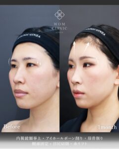 アイホールボーン削り術前術後1ヶ月 左斜め45度 目尻側の影の変化