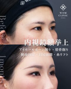 内視鏡額挙上と骨削り 術前と術後1ヶ月 斜め目元の比較