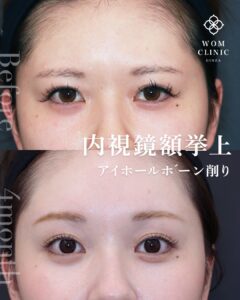 内視鏡額挙上 内視鏡前額リフト アイホールボーン削り