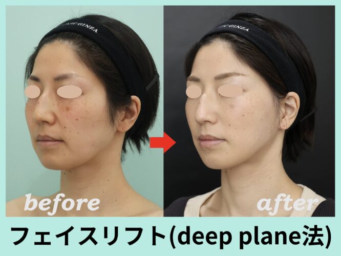 フェイスリフト手術 deep plane face lift