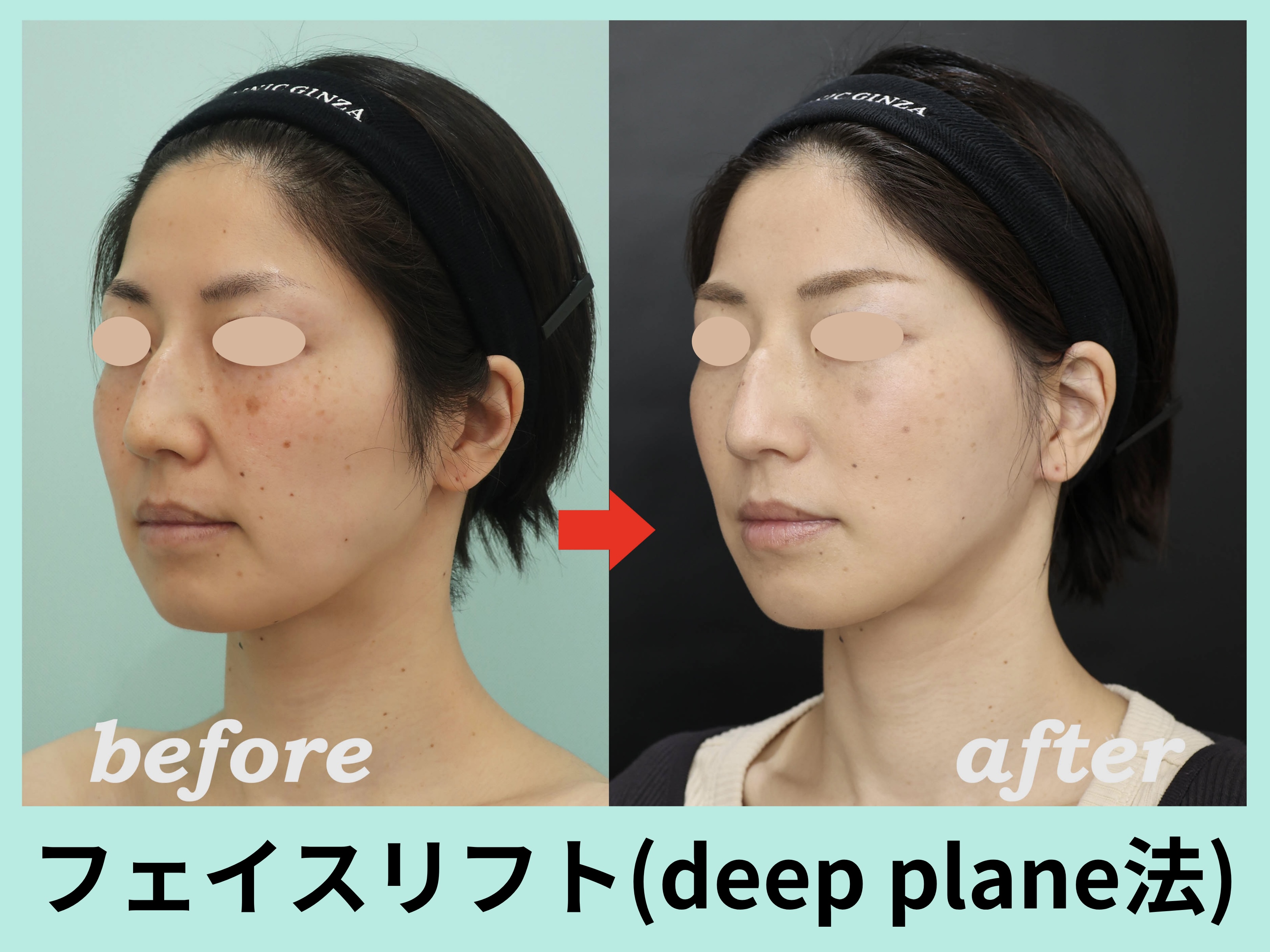 フェイスリフト手術 deep plane face lift