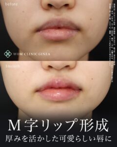 M字リップ形成