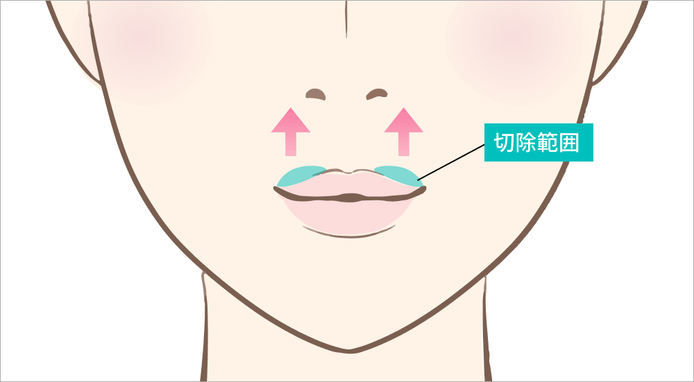 外側人中短縮
