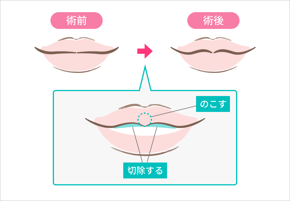 M字リップ形成術