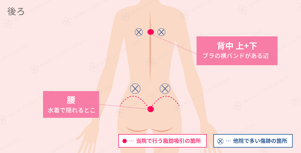 背中の脂肪吸引の傷跡