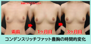 CRF豊胸正面術前・1M・3M 枠付き