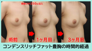 CRF豊胸右斜位術前・1M・3M