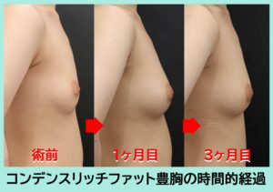 CRF豊胸術前・1M・3M